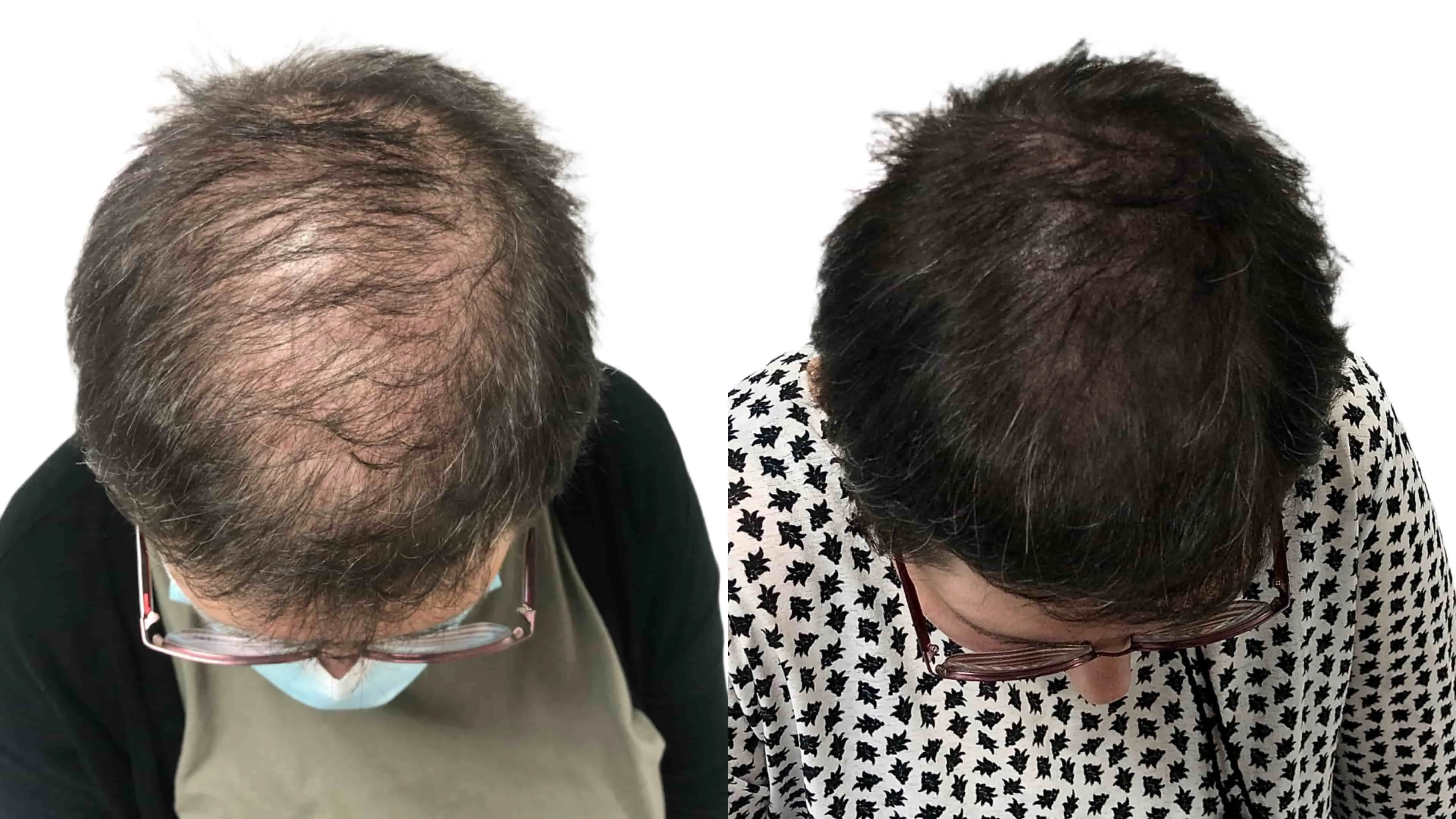 SMP za ženske – redki lasje, zmanjšan volumen